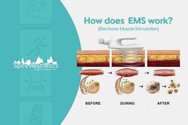 EMS treatment for post pregnancy weight loss treatment Maldon