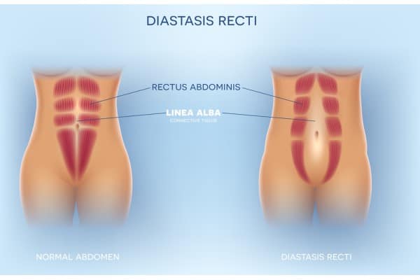What Non-Surgical Options Are Available for Diastasis Recti Maldon?
