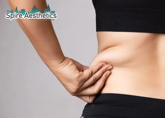 Image of woman pinching fat on their hips Maldon. Fat Freezing treatment