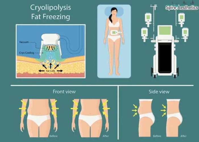 Fat freezing treatment Maldon benefits for competitions to remove stubborn fat deposits.