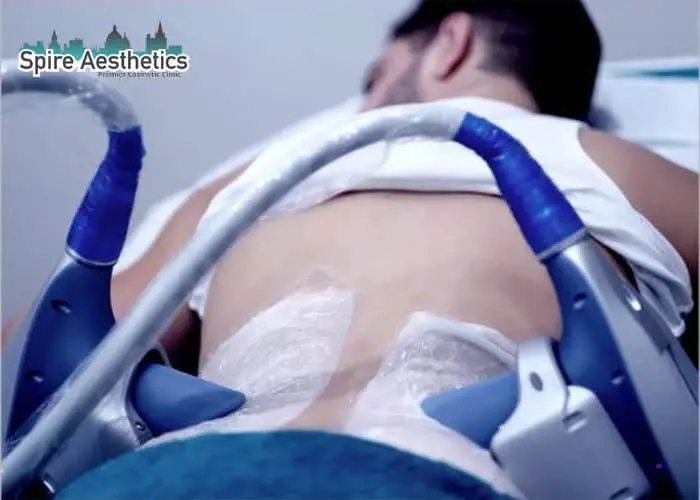 Man having fat freezing treatment done on love handles before a competitions Maldon to create a sculpted look.