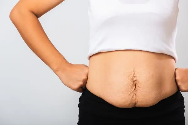 Image of a woman's stomach after weight loss with sagging skin following a gastric band Maldon