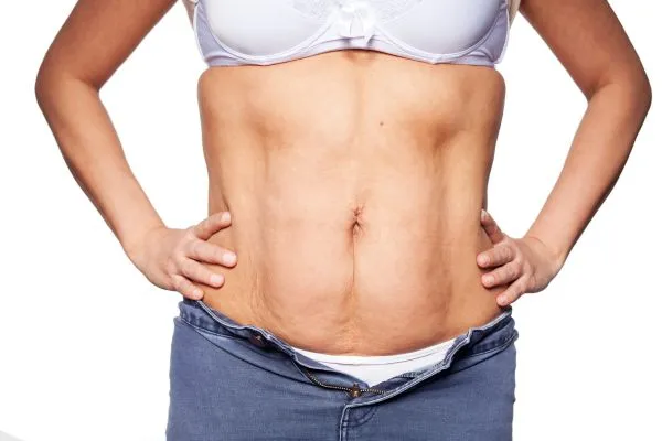 sagging skin on woman's stomach after weight loss injections Maldon