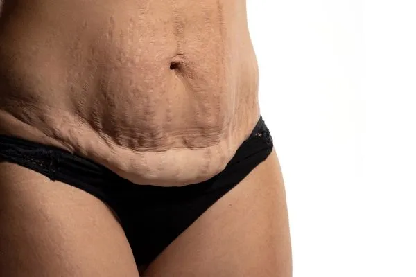 Image of womans stomach after weight loss injections Maldon showing saggy skin