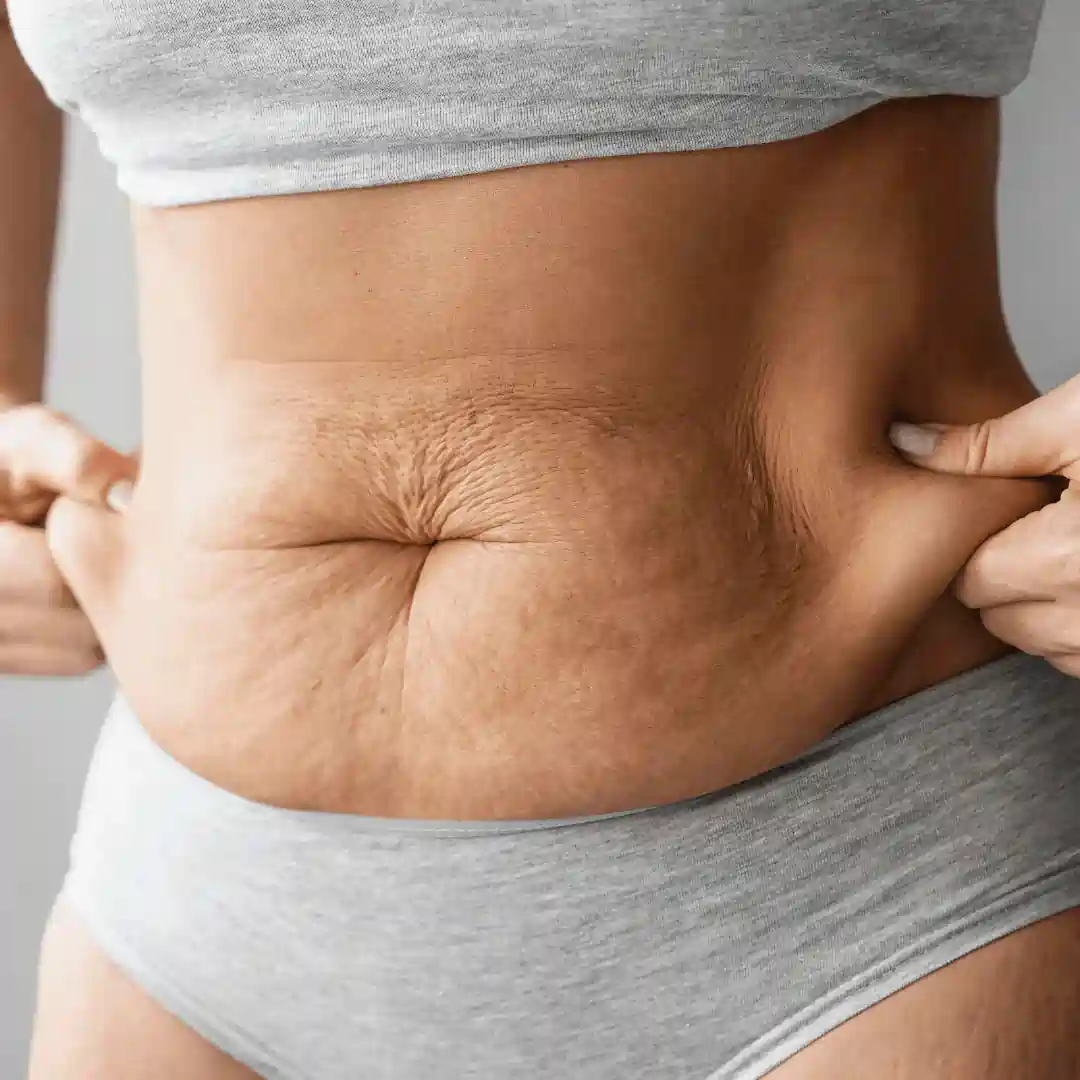 Is It Normal to Have Loose Skin After Pregnancy Maldon?