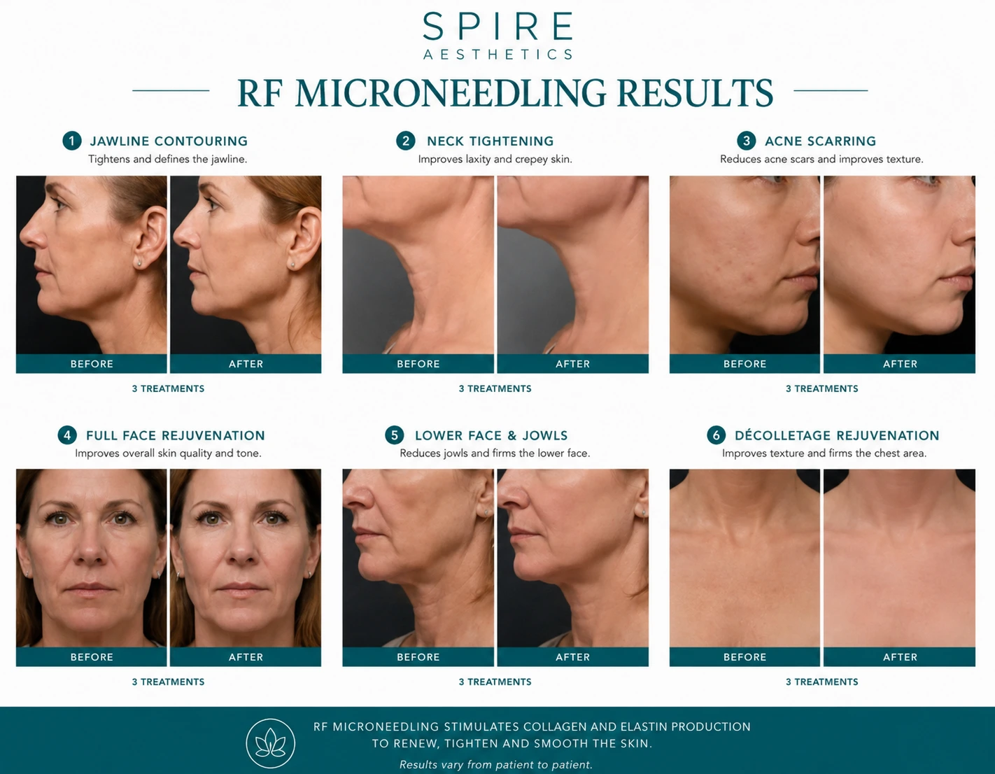 RF Microneedling Skin tightening Maldon results