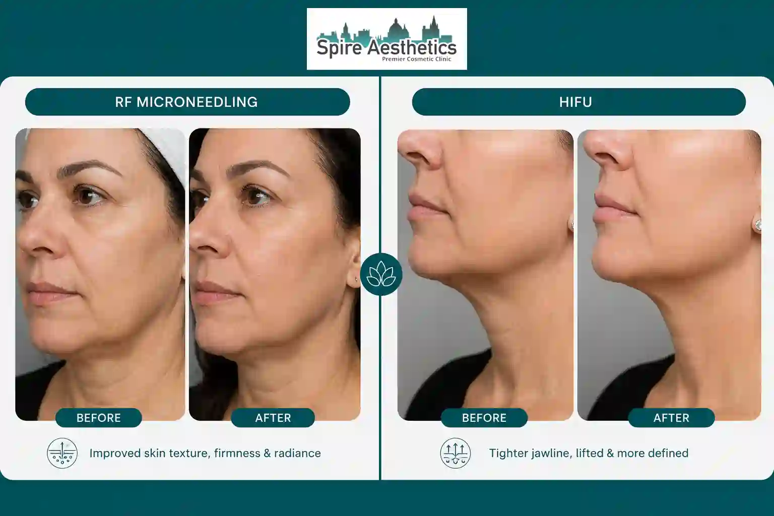Can RF Microneedling and HIFU Be Combined Maldon?