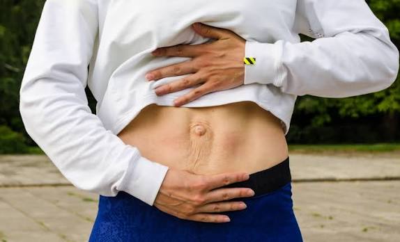 When Could Diastasis Recti Be the Missing Piece of the Puzzle Maldon?