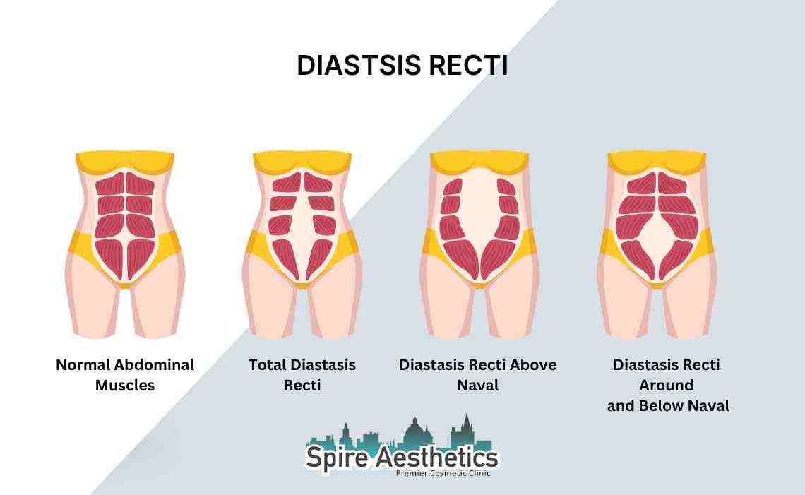 Is Non-Surgical Diastasis Recti Treatment Right for You? Common Concerns Answered Maldon